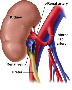 renal transplantation
