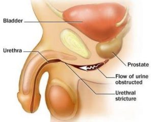 Stricture urethra